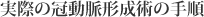 実際の冠動脈形成術の手順