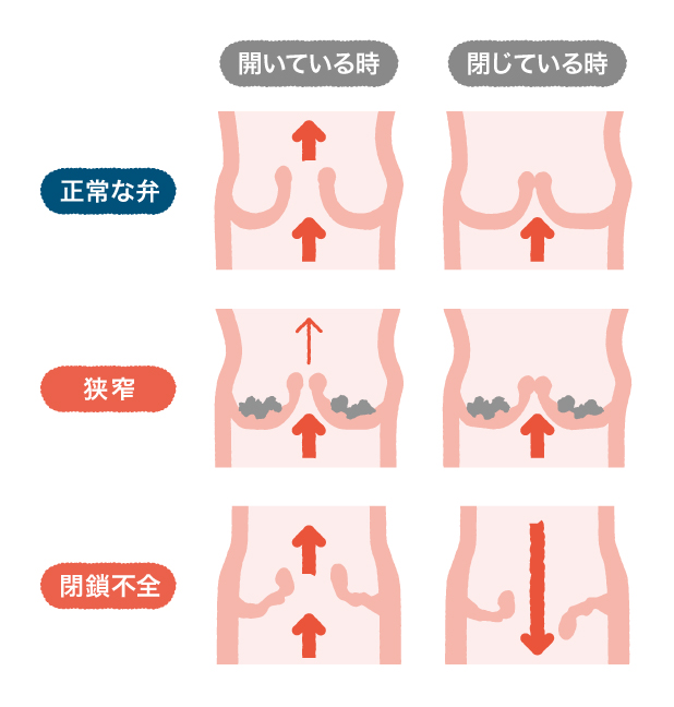 正常な弁_狭窄_閉鎖不全